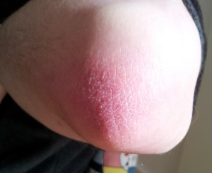 Picture of my elbow